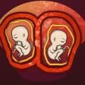 Fœtus d'une grossesse bichoriale biamniotique dans 2 placentas et 2 poches amniotiques différentes